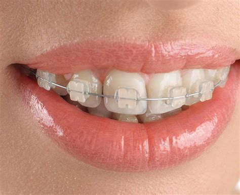 clear brackets with metal wire|clear braces no metal bands.